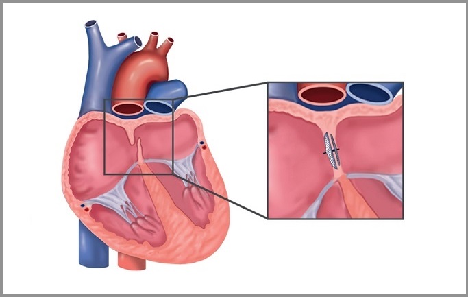 Late Follow up of PFO Closure for Stroke Raises Questions for